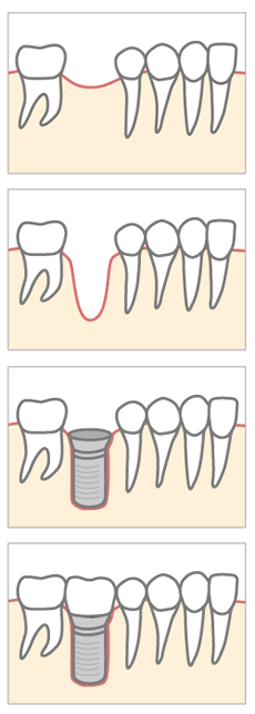 インプラント治療の流れ